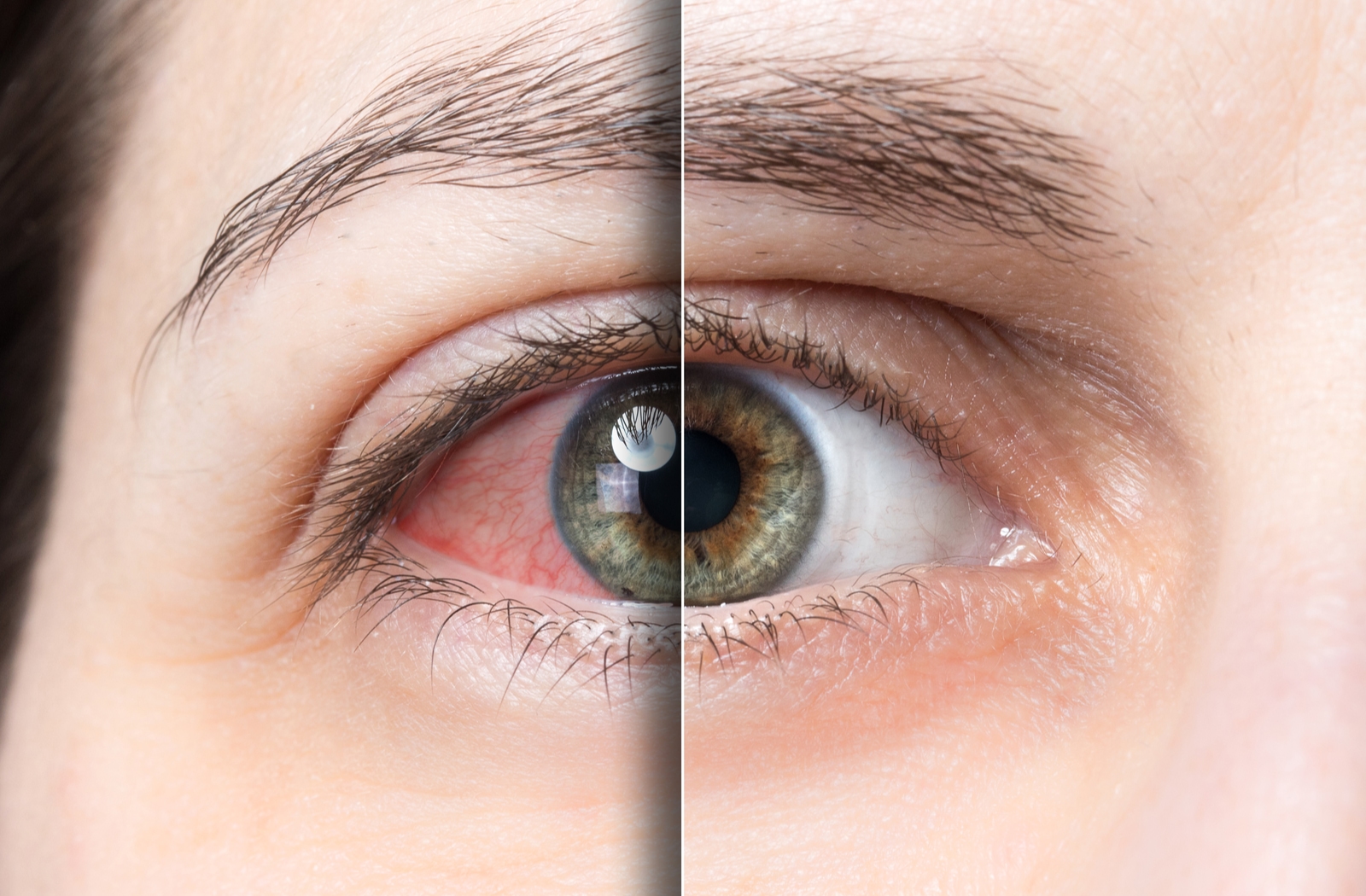 Can Intense Light Therapy Treat Dry Eye? | Amarillo