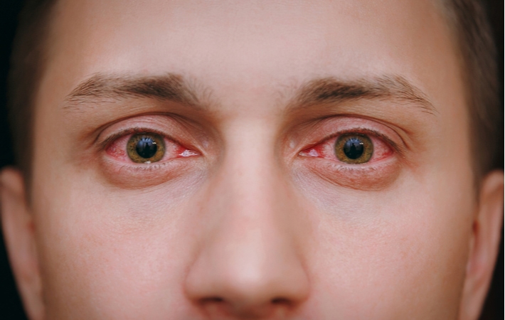 A person suffering from Viral Conjunctivitis that has spread to both eyes making them pink and swollen