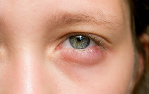 A female patient displaying an inflamed lower eyelid, a symptom of blepharitis