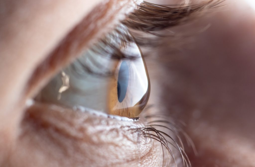 Close up view of an eye with keratoconus, a type of astigmatism