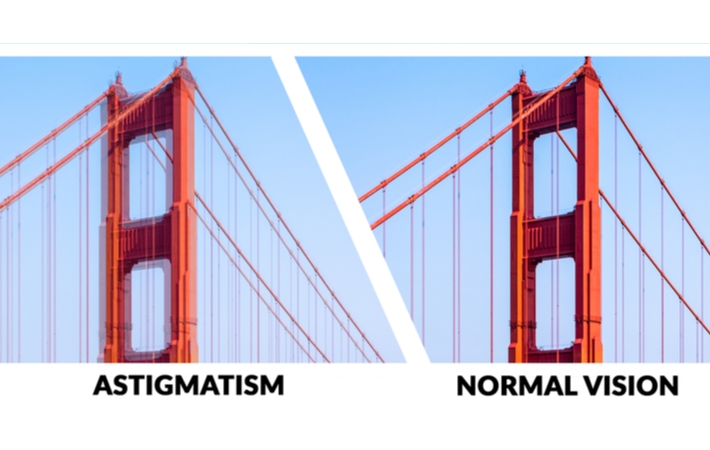 Side by side comparison of the San Francisco bridge showing blurry on left because of astigmatism, and regular in focus on the right