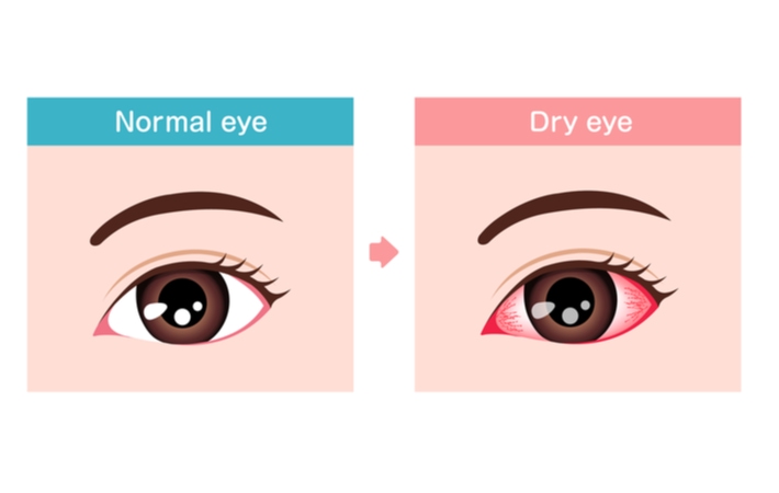 Graphical representation comparing a normal eye to dry eye