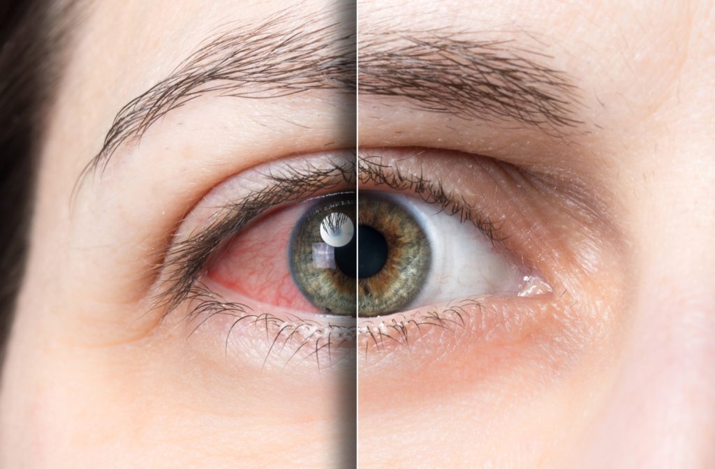 Close up an eye separated by a line showing a normal eye versus a red dry eye.