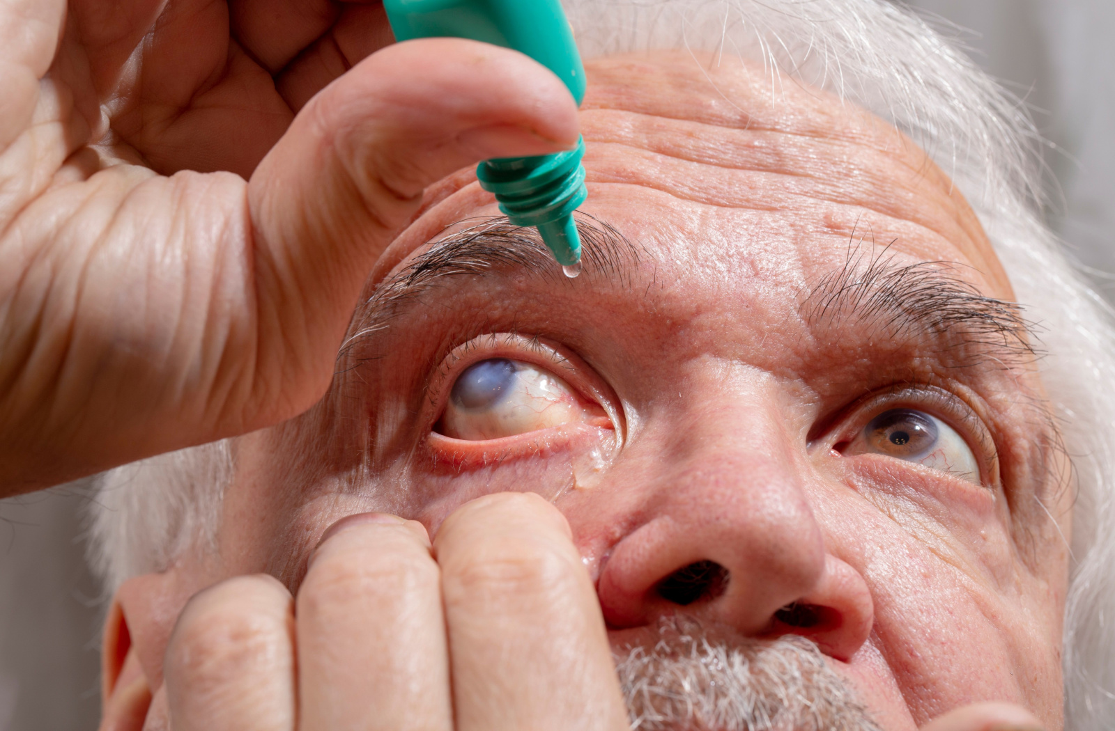 An older man carefully administers eye drops to alleviate symptoms of his cataract, seeking relief and maintaining his ocular health.