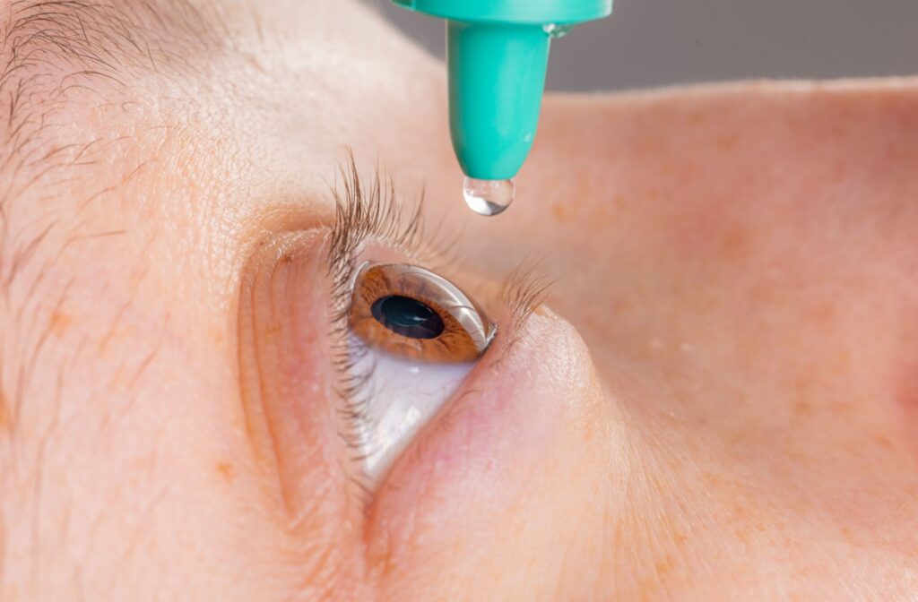 Close-up of an eye receiving glaucoma treatment with medicated eye drops.