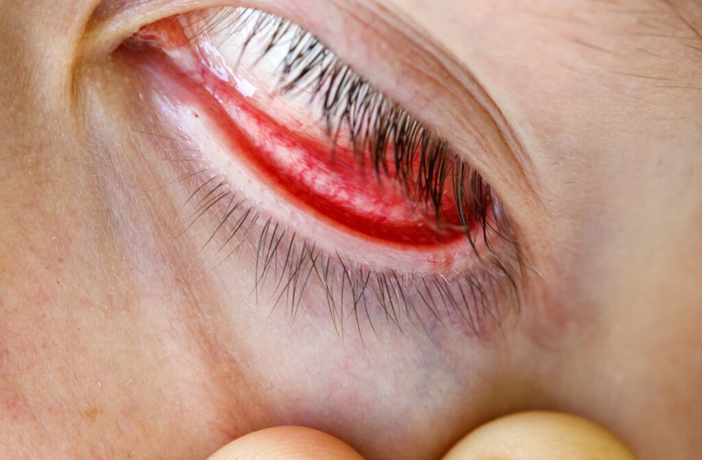 Close-up of a human eye with the lower eyelid pulled down, showing a red and irritated inner eyelid lining (conjunctiva). The sclera (white of the eye) appears visible above, while eyelashes are pointing downward.