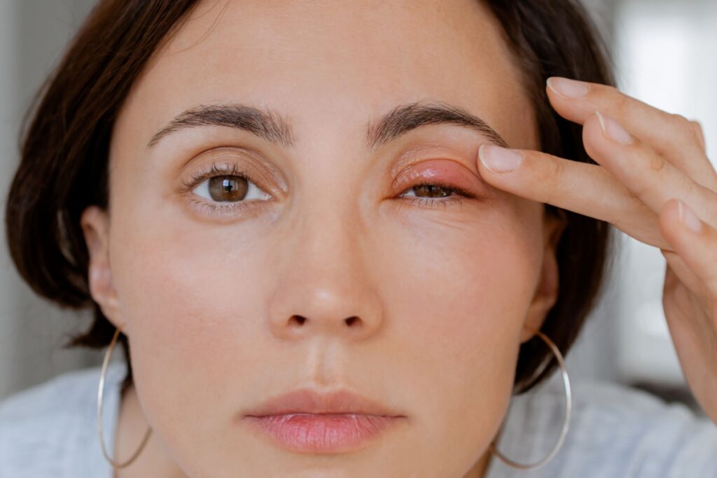 A woman lifting her eyelid to show redness and swelling, possibly from an eye infection or irritation.
