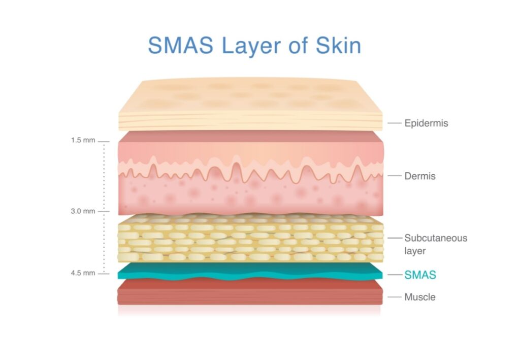 Cross section diagram of the layers of skin showing the SMAS layer.