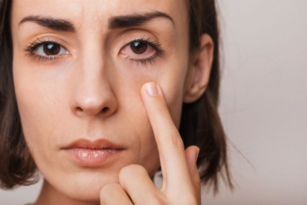 Close-up of a woman's face showing one normal eye and one red, irritated eye, as she points her finger toward the bloodshot area with a serious expression.